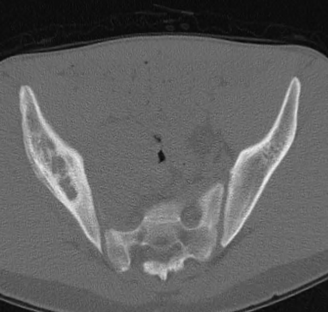 Figure 3 for case Ewing sarcoma ( RID4522 )